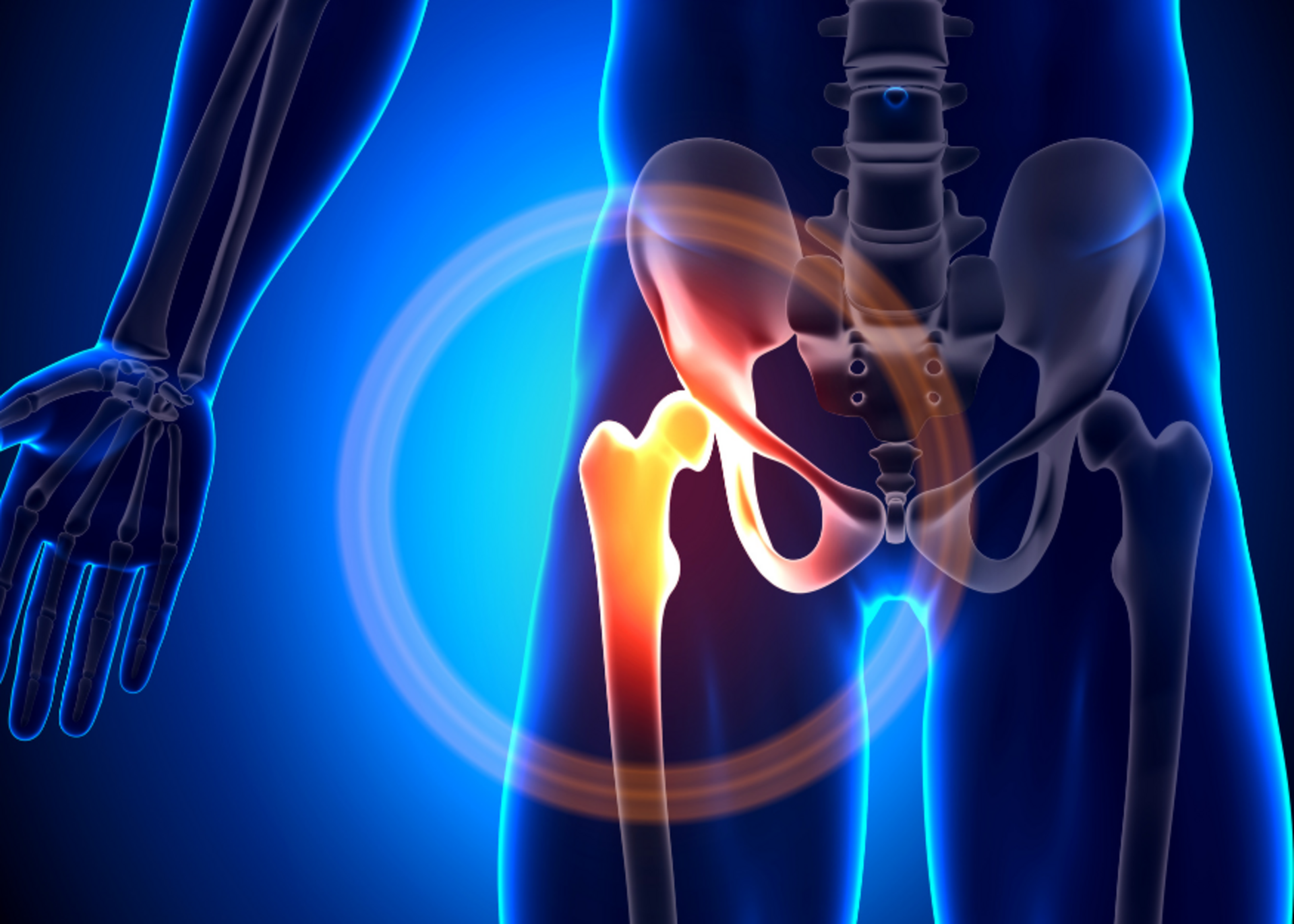 Hip Replacement Surgery