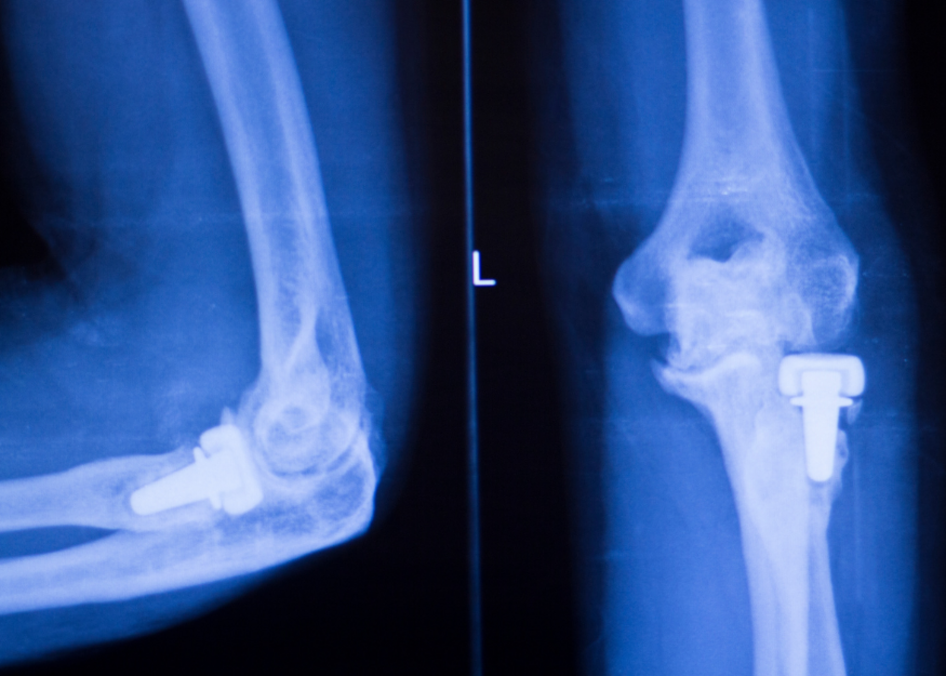 Elbow Replacement Surgery