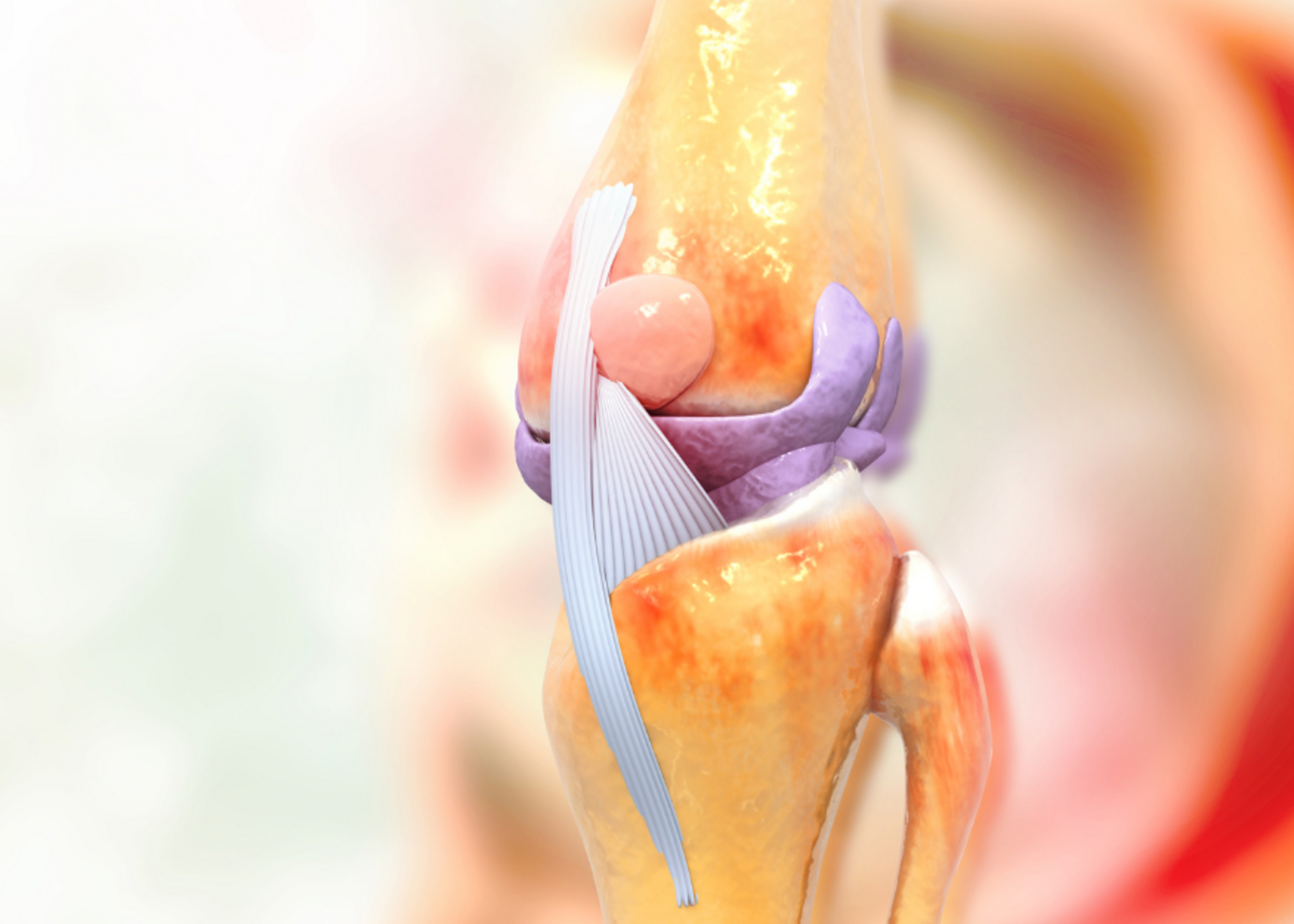 Revision Joint Replacement