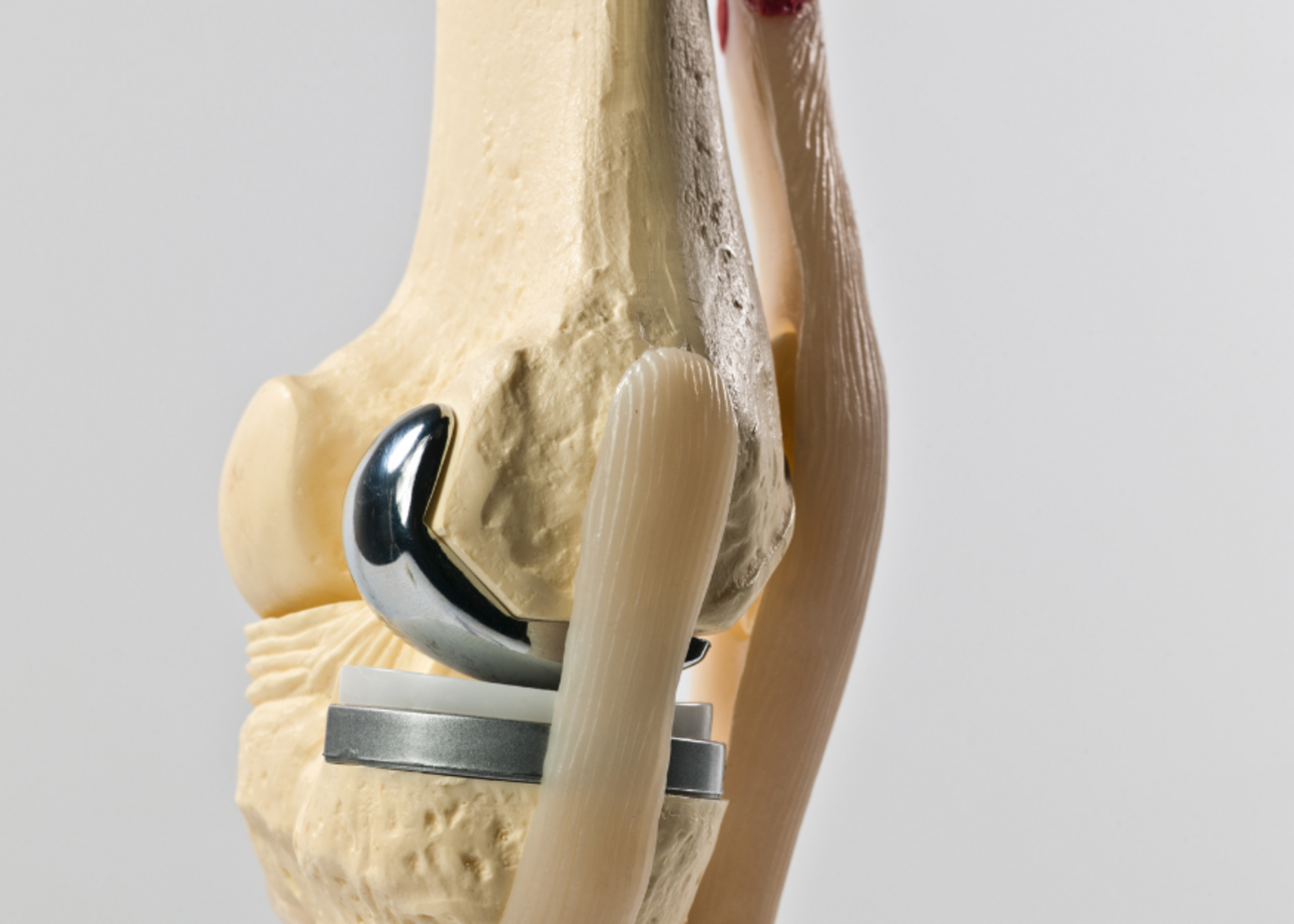 Partial knee replacement